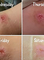 A series of days of a wound healing after using Goodwood Produces MGO honey.