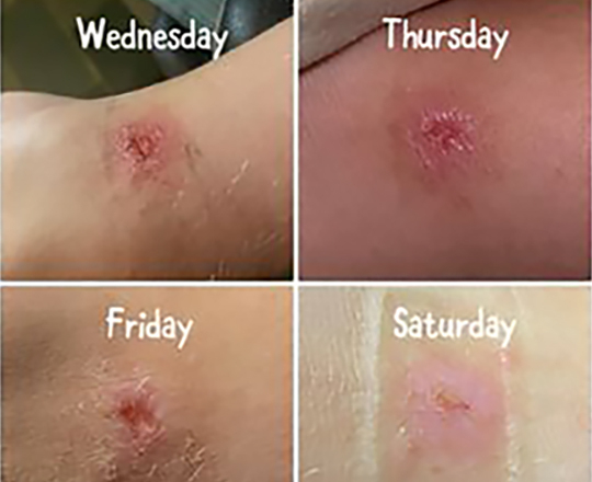 A series of days of a wound healing after using Goodwood Produces MGO honey.